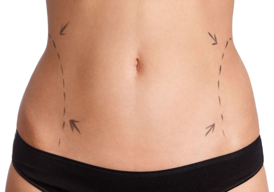 Laser lipolysis can be practiced on all parts of the body