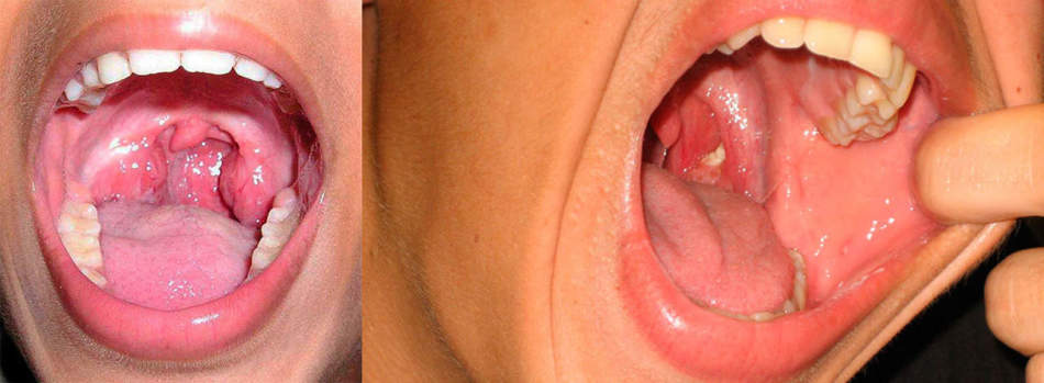 Manifestations of purulent sore throat