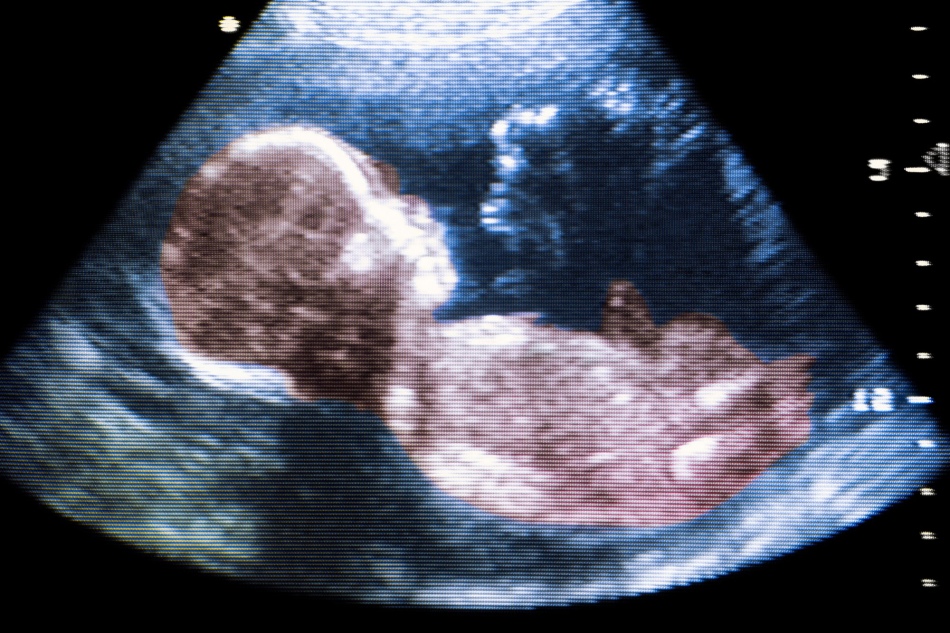 The umbilical cord can be seen on the computer screen with ultrasound