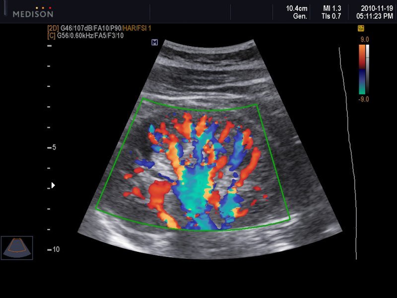 Доплер почек. Допплерография сосудов при беременности. Допплеровская сонография. Ультразвуковая допплерография сосудов почек. УЗИ С доплером при беременности.
