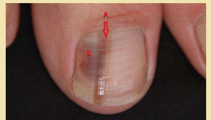 Меланонихия: чернеют ногти на пальцах ног
