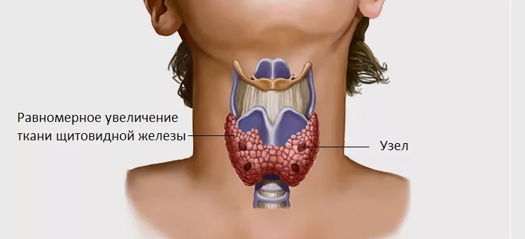 Model pada kelenjar tiroid