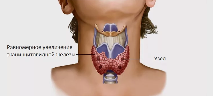 نماذج على الغدة الدرقية الغدة الدرقية