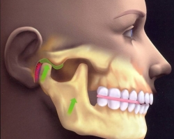 Bolest, patologija, disfunkcija vremenskog zgloba mandibule: uzroci, simptomi, dijagnoza, liječenje