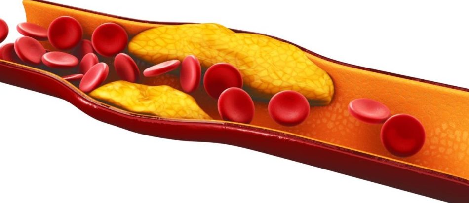 Cholesterol and triglycerides are increased