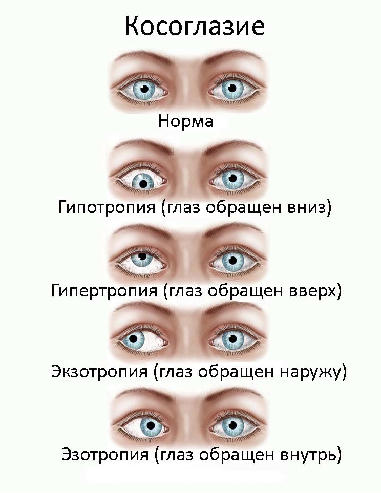 Types of strabismus.