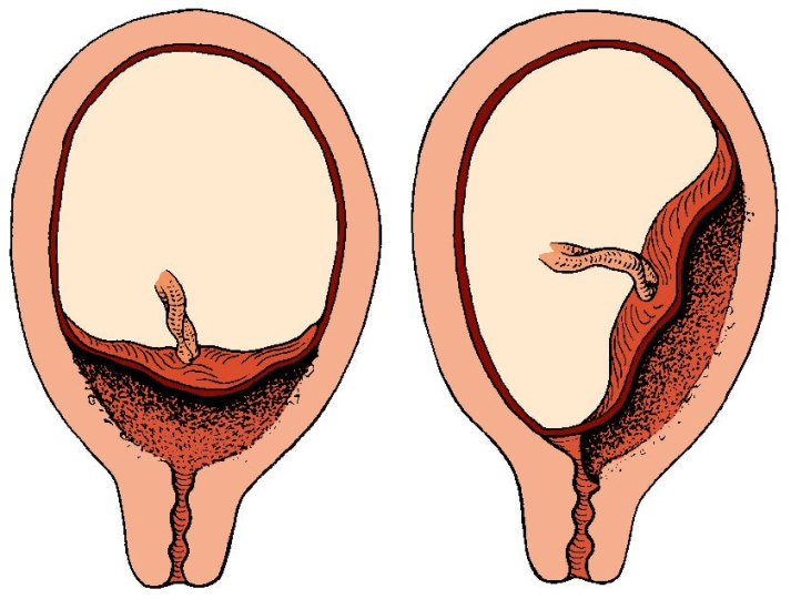 Pathologie du placenta pendant la grossesse