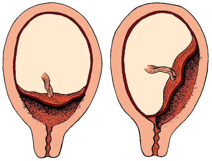 Pathology of the placenta during pregnancy