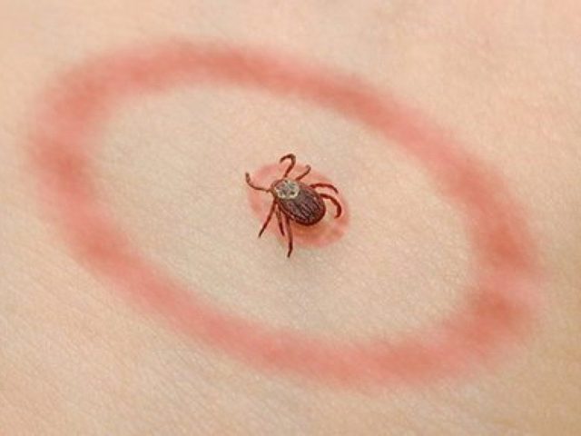 Lyme Disease: Τι είναι, ποιος είναι ο αιτιολογικός παράγοντας, τα συμπτώματα, οι προβλέψεις