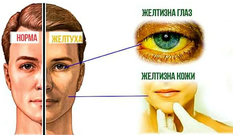 Если желтеет кожа, лицо, тело, глаза человека, то это может быть причиной серьезной болезни
