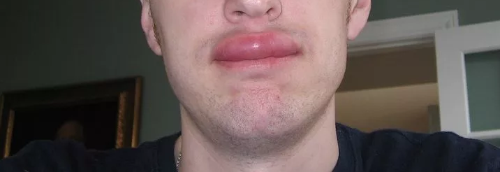 The tooth hurts, swollen lip