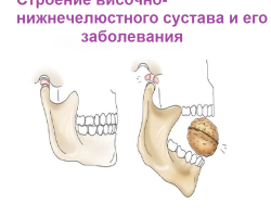 The temporomandibular joint: structure, anatomy, blood supply, innervation, movement, muscles, bones, articular surfaces, disk, capsule, classification, functional features, characteristics. IMFs diseases, types of diagnosis: pain syndrome, symptoms, arthrosis, arthritis, MRI, treatment, dislocation, subluxation, x -ray, inflammation, ankylosis, balancing, doctor that treats
