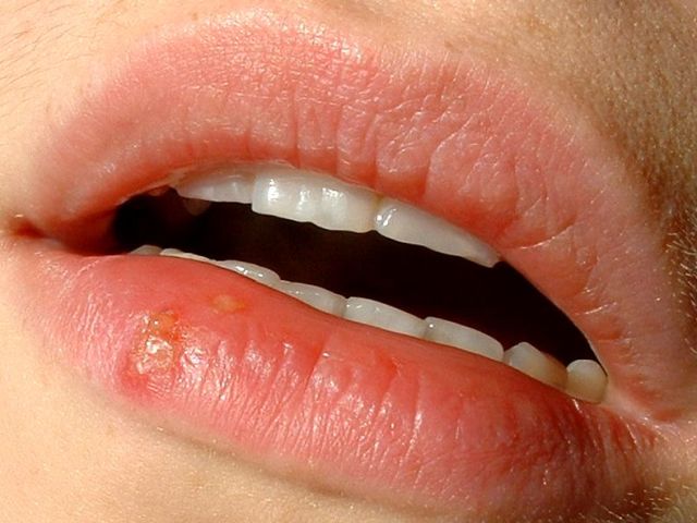 Herpès sur les lèvres pendant la grossesse: danger, conséquences, traitement. Causes d'herpès sur les lèvres de 1, 2 et 3 trimestres de grossesse