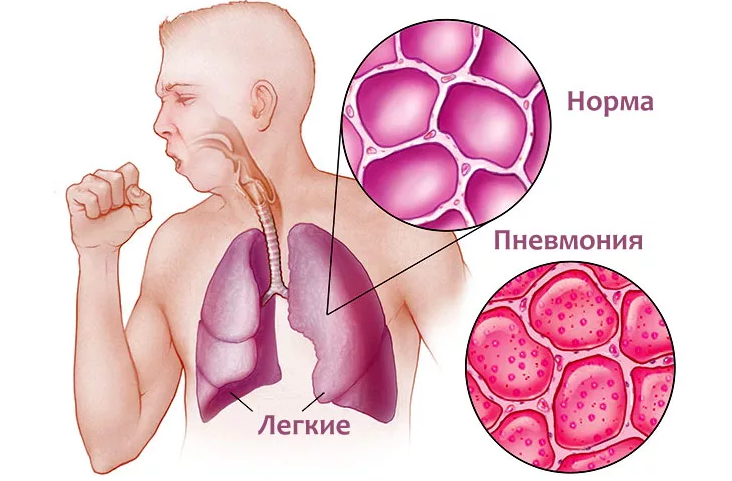 Znaki in simptomi pljučnice