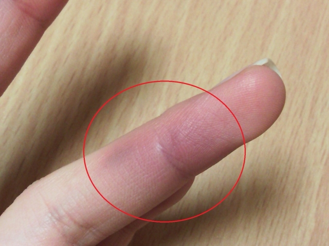 Травма ногтя на руке - причины, симптомы, цены на лечение травмы ногтя на руках в Москве