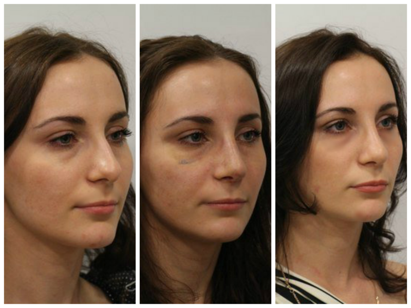 Как меняется нос после ринопластики по месяцам фото