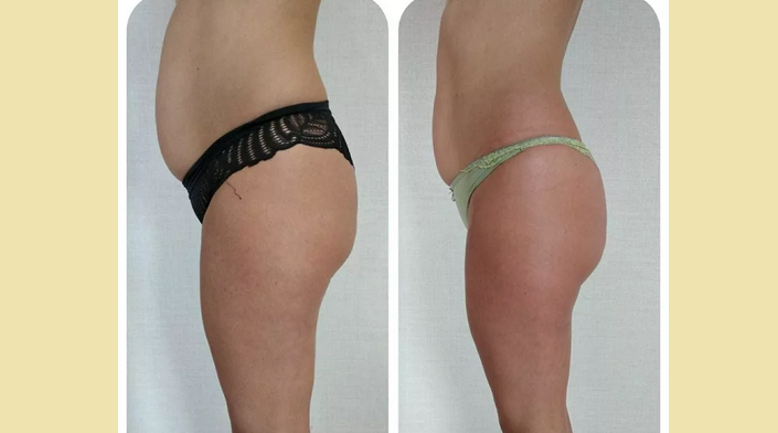 Rezultat po masaži pločevinke: fotografija pred in po njem