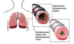 Prévention de l'asthme bronchique chez les adultes