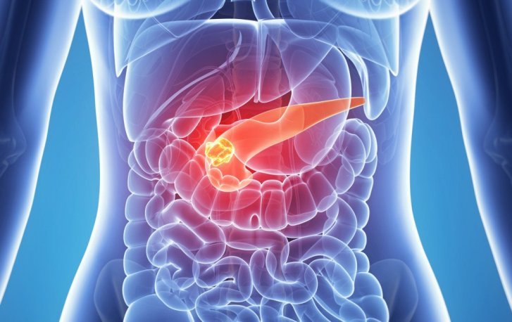 Chronic pancreatitis