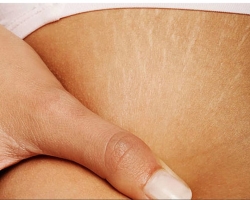 How to remove stretch marks after childbirth? Skin care after childbirth