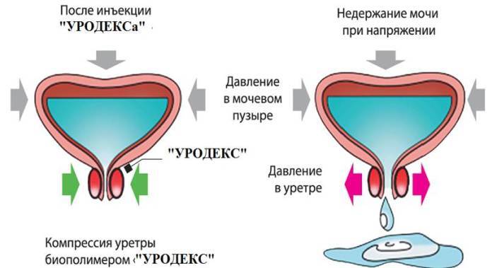 Inkontinenca urina pri ženskah: zdravljenje