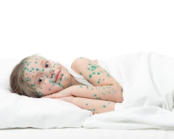 How many days is the incubation period, the contrast of chickenpox in children and adults?