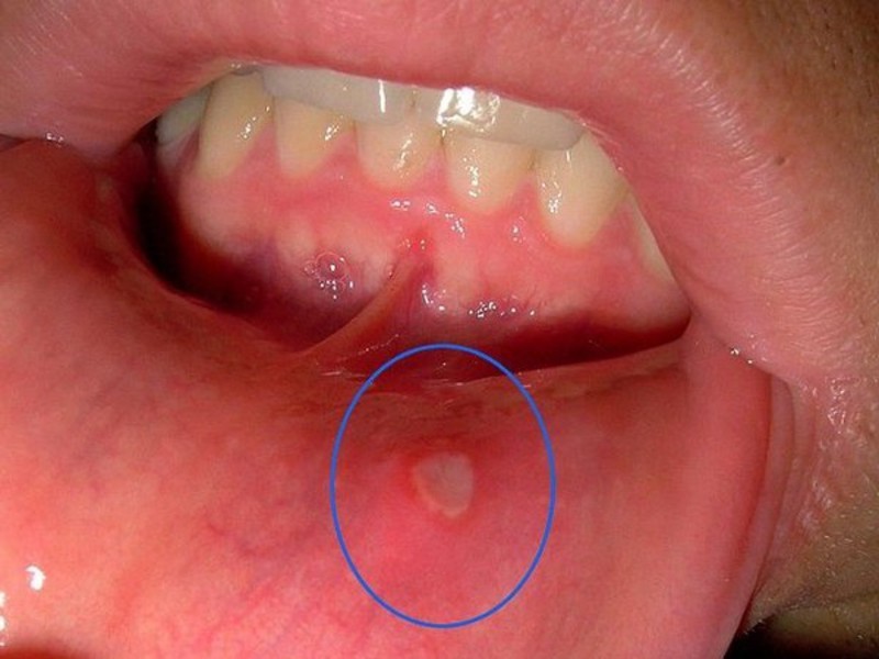 Причина жжения во рту: афтозный стоматит.