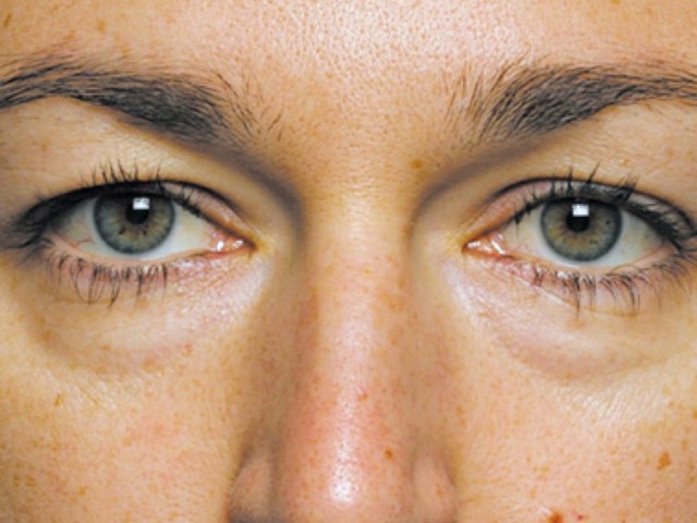 Eye tumor: Reasons, how to get rid of when to see a doctor immediately?