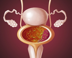 Mit nem lehet tenni a nők cystitis -jével - hogyan nem kezelhető?