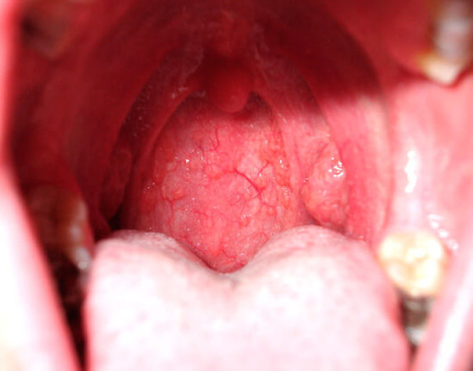 Видно воспаление на задней стенке горла — типичный признак вирусной инфекции