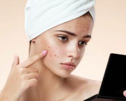 Dreams of Pimple, Apa Jerawat Bermimpi - Makna dan Interpretasi Di sepanjang Buku Impian Paling Populer