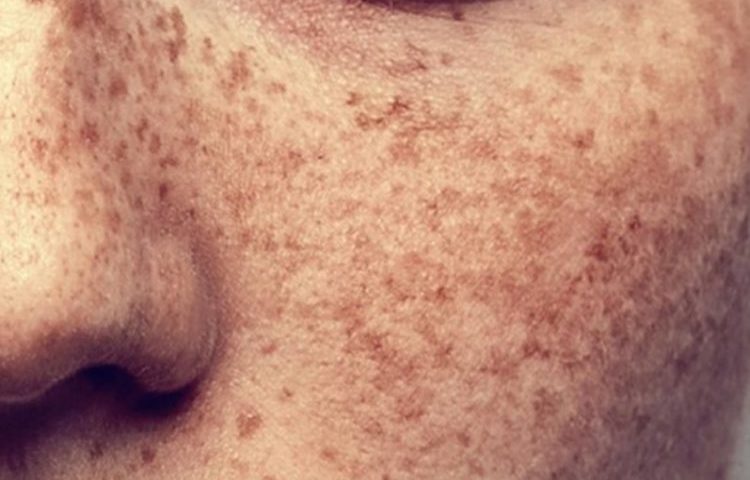 Hiperpigmentacija kože: vzroki in zdravljenje