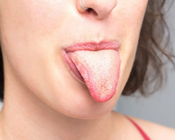 White, yellow, gray, green plaque in the tongue in adults: a sign of what, the symptom of which disease?