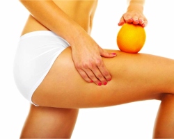 Come sbarazzarsi rapidamente della cellulite? Prodotti anti -cellulite efficaci, procedure termiche, esercizi, diete