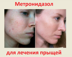 Effektiviteten av metronidazol vid behandling av akne i ansiktet: mekanismen för handlingen av antibiotikumet, hjälper det, recept av masker, chatterboxar, masker
