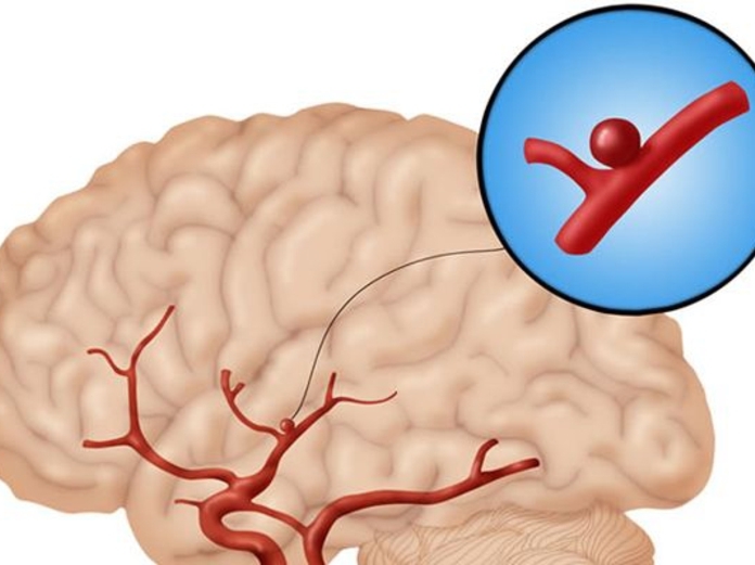 Аневризмы сосудов головного мозга лечение народными средствами