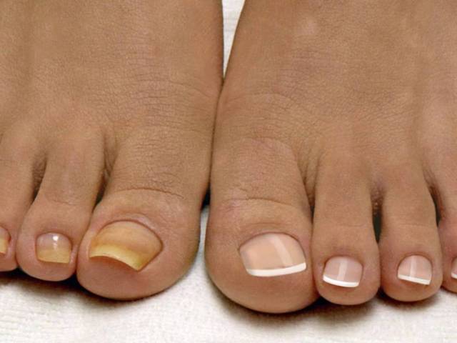 Ногти на пальцах ног желтеют, чернеют, белеют, отходят и слоятся — почему: причины, лечение, профилактика