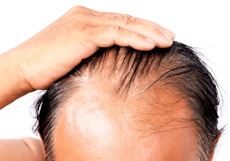 От простатита волосы могут выпадать волосы