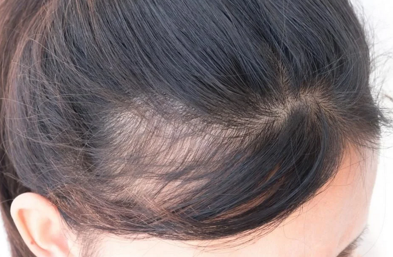 Perte de cheveux chez une femme