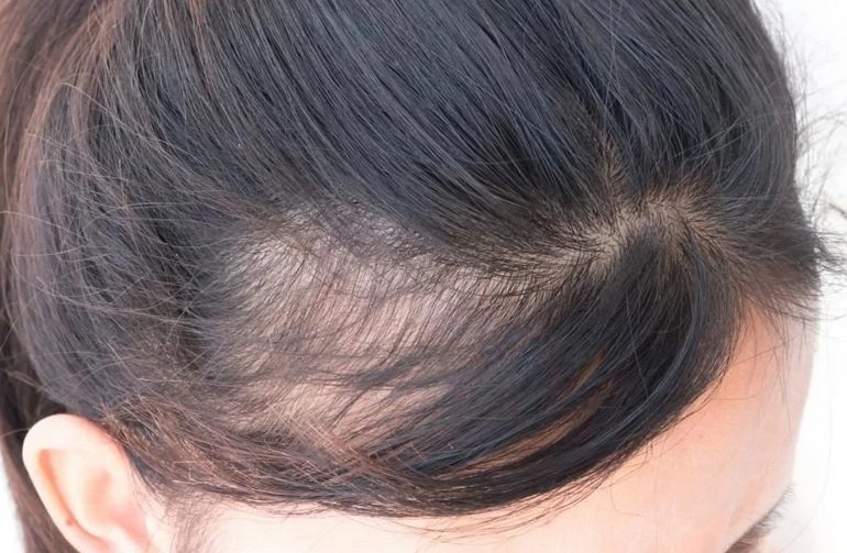 Hair loss in a woman