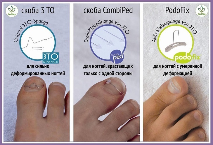 Скобы для лечения вросших ногтей