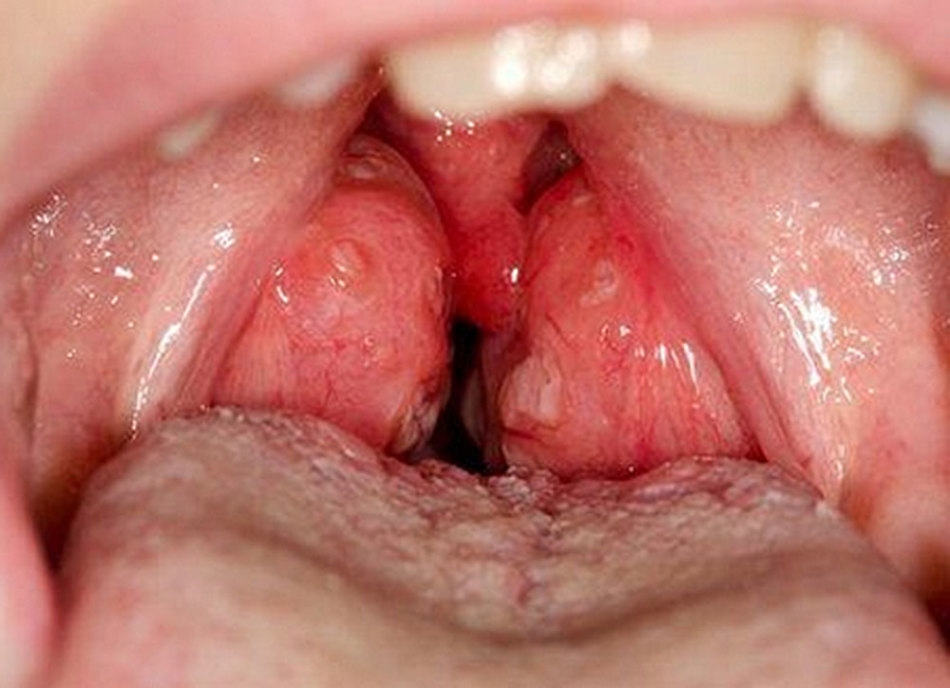 Tonsil hipertrófia - indikáció a tonsillectomy -ra