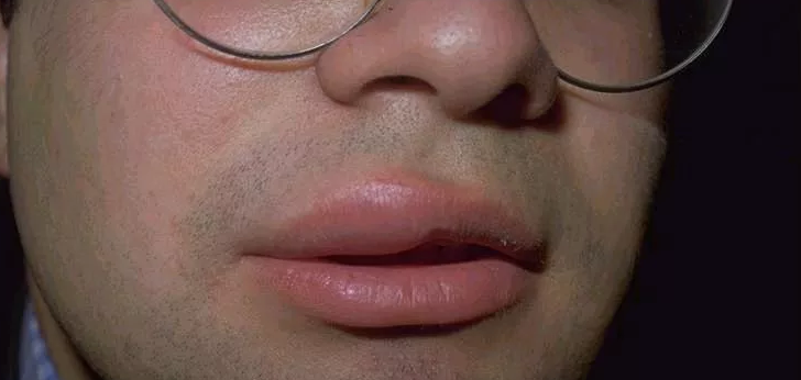 Τα χείλη ενός ενήλικα στο εξωτερικό, μέσα χωρίς λόγο και πόνο, ήταν πολύ πρησμένα