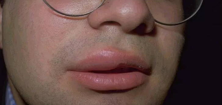 Los labios de un adulto en el exterior, por dentro sin razón y dolor, estaban muy hinchados