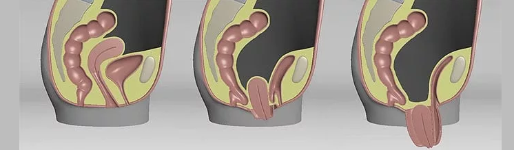Labber și prolapsul uterului: etape