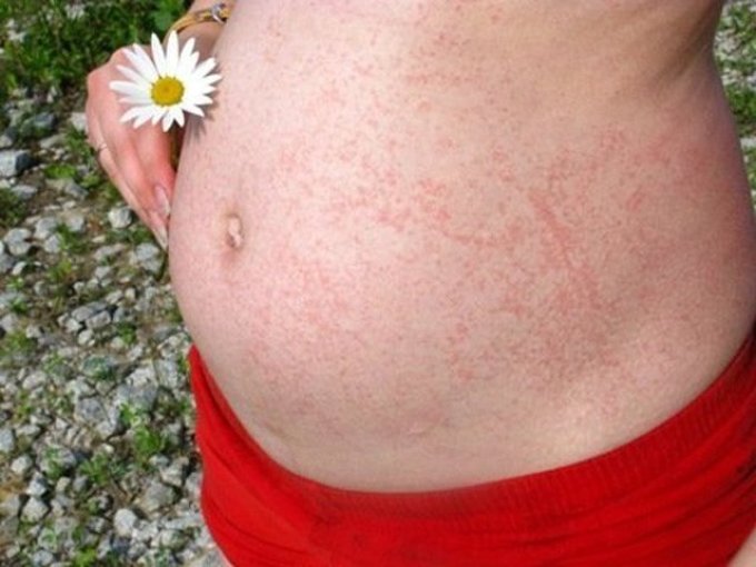 Dermatitis during pregnancy