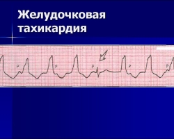 Tachycardie ventriculaire: causes, symptômes, traitement