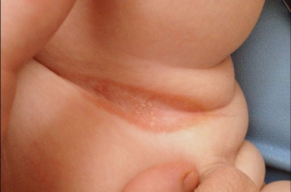 Diaper rash in the groin of women: photo