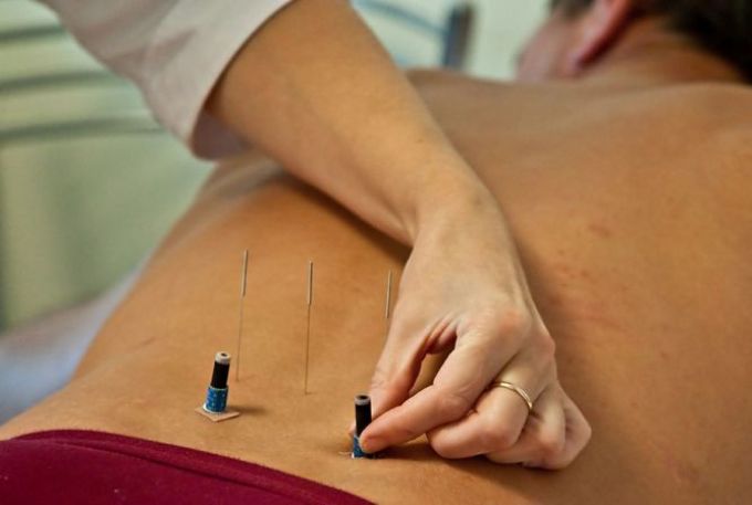 Hogyan kell kezelni az izhias akupunktúrát?