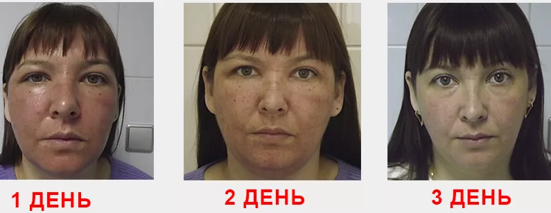 Facial edema after photography